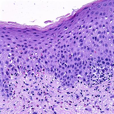 The Role of Eosinophils in Bullous Pemphigoid: A Developing Model of Eosinophil Pathogenicity in Mucocutaneous Disease